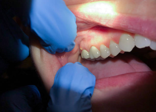 Best Broken or Chipped Tooth Repair in Westmont, NJ